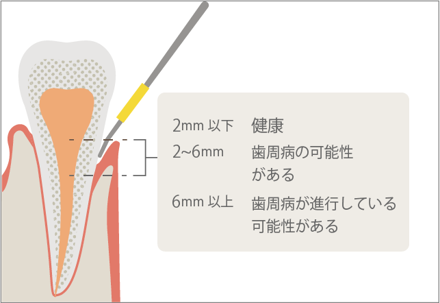 スケーリング（歯石取り）