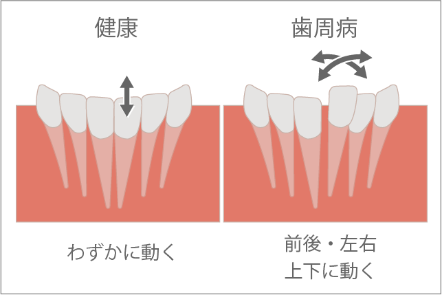 PMTC(クリーニング)